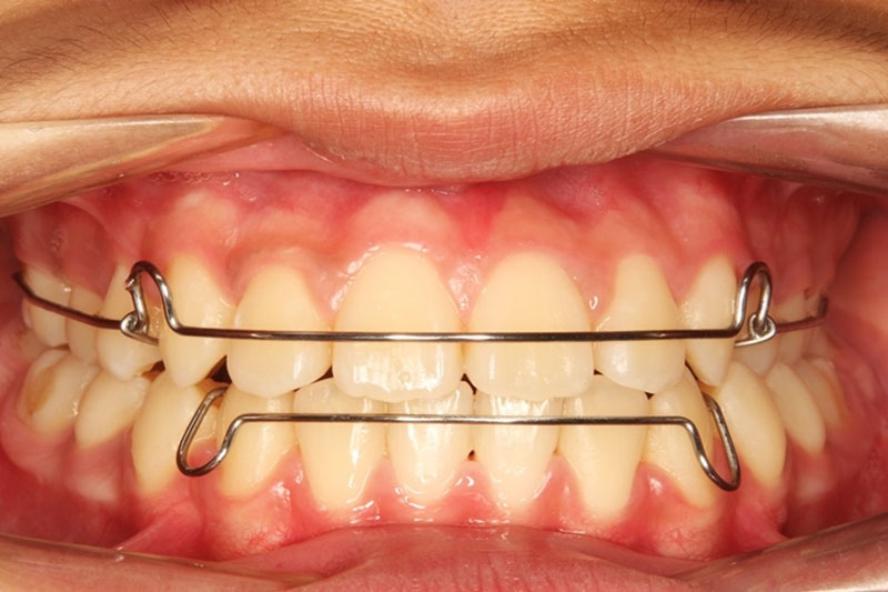 Sau tháo niềng bạn sẽ cần đeo hàm duy trì để ổn định răng đã dịch chuyển