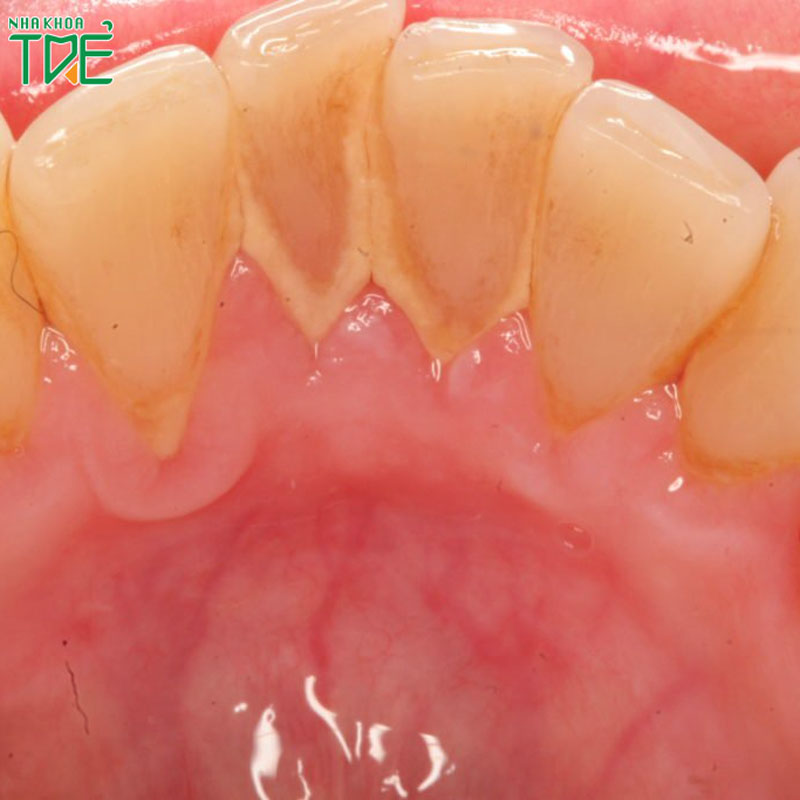 Răng có mảng bám ố vàng phải làm sao?