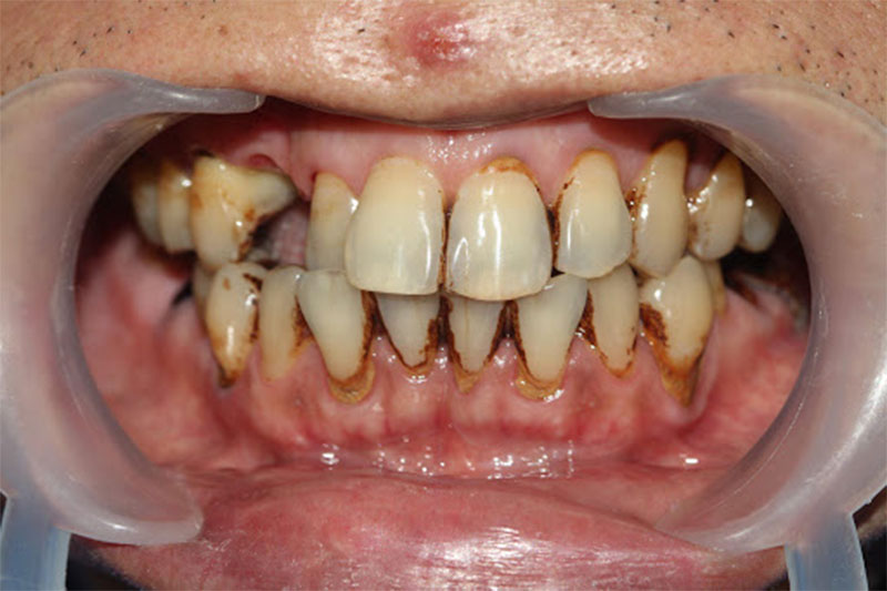 Cao răng nặng sẽ gây viêm nhiêm, tụt nướu lợi