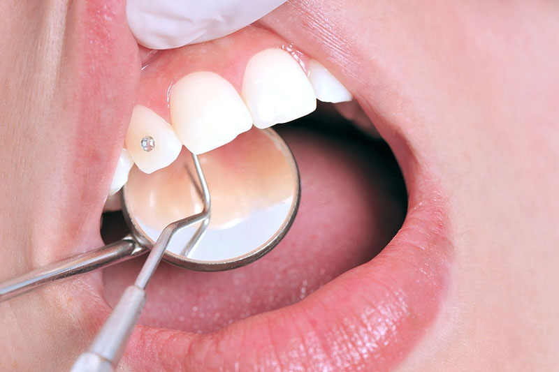 Nên điều trị bệnh lý răng miệng trước khi đính đá