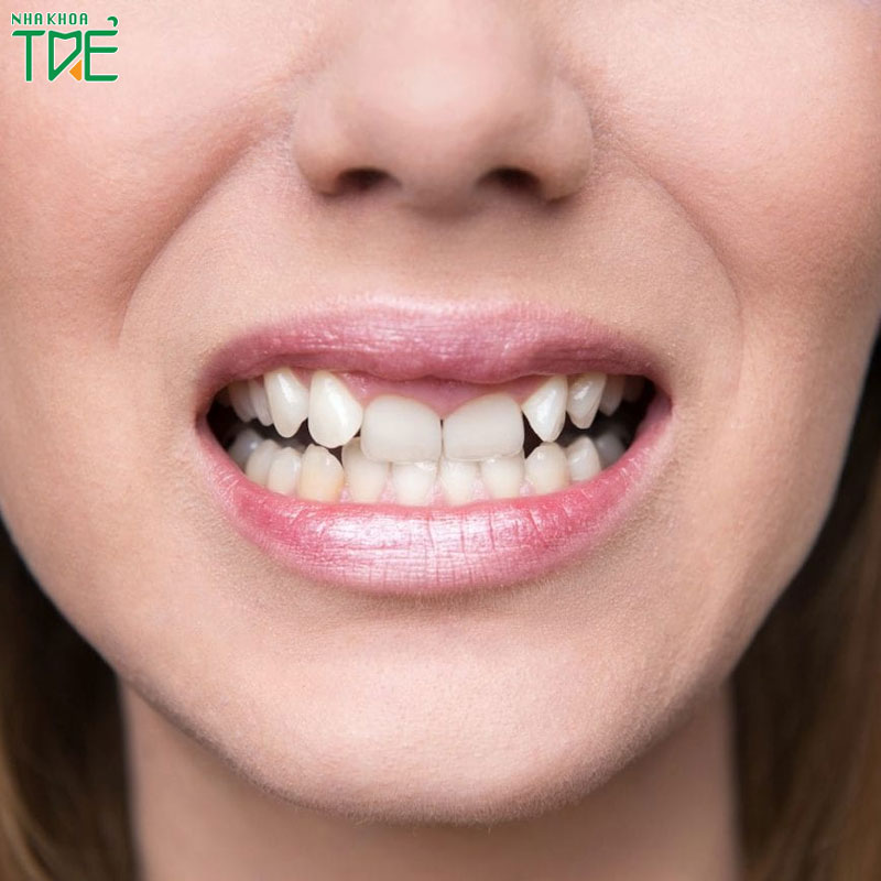 Răng khấp khểnh nên làm gì? Nên bọc răng sứ hay niềng răng