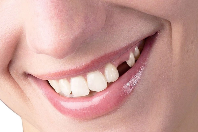 Mất răng nanh số 3 gây ảnh hưởng nghiêm trọng đến thẩm mỹ khuôn mặt