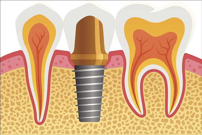 Trồng răng Implant cho răng số 5 bị mất là giải pháp phục hình hiệu quả