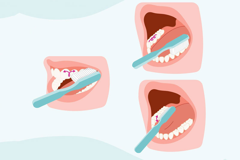 Vệ sinh răng miệng đúng cách sẽ ngăn ngừa được bệnh lý sâu răng viêm lợi