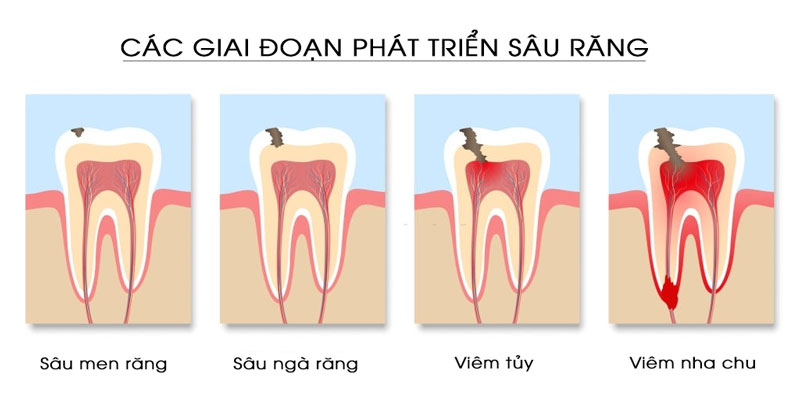 Sâu răng tiến triển theo từng giai đoạn