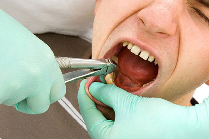 Nhổ răng sâu để đánh viêm nhiễm lan rộng