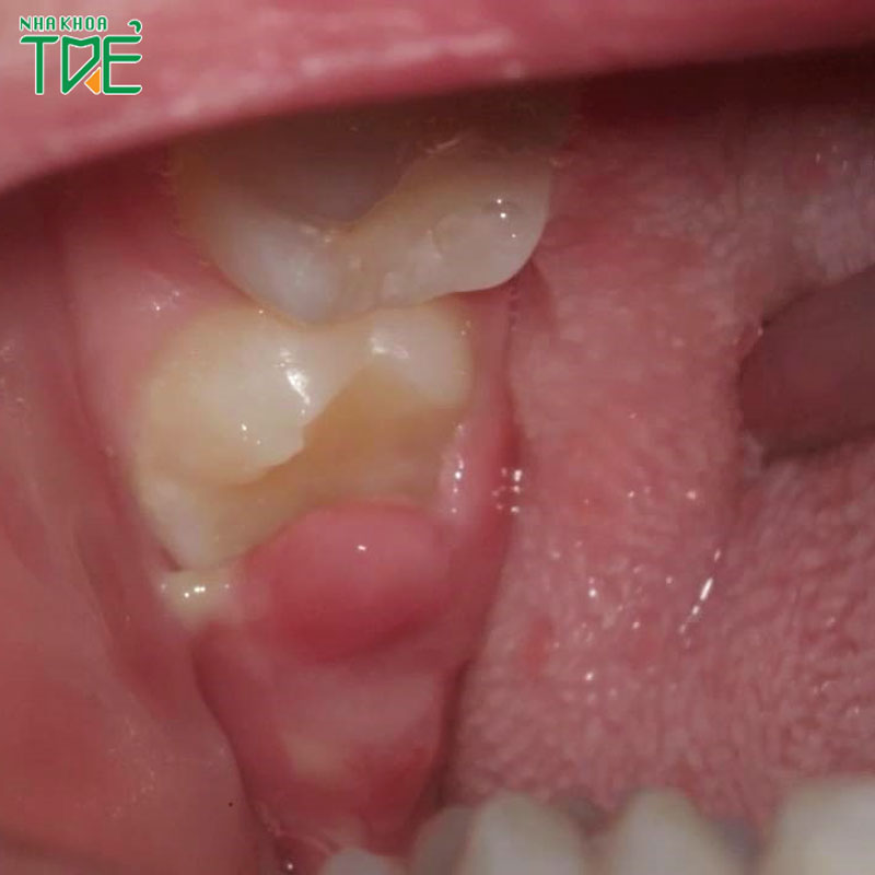 Sưng lợi ở răng hàm: Nguyên nhân và cách điều trị dứt điểm