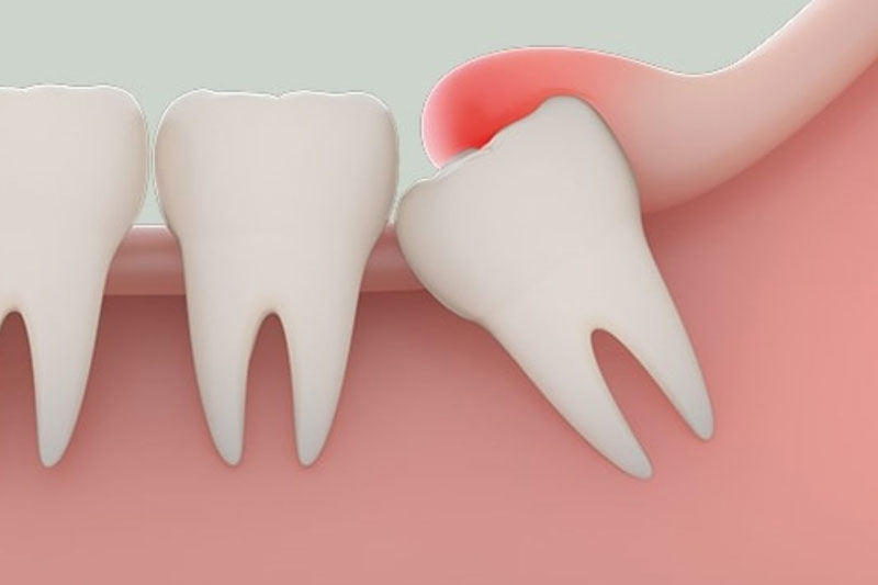 Sưng lợi trong cùng do mọc răng khôn sẽ gây nhiều biến chứng nguy hiểm