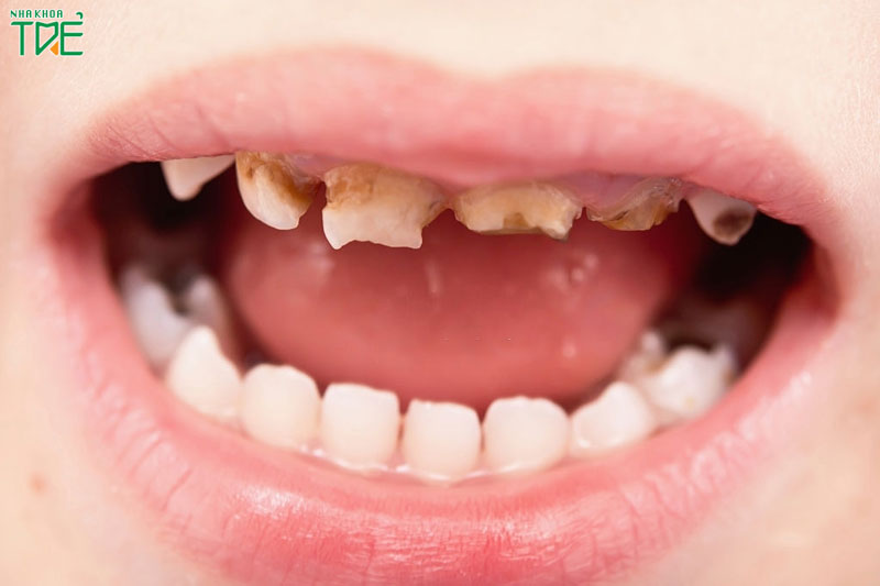 Trẻ em bị sún răng viêm lợi phải làm sao để khắc phục?