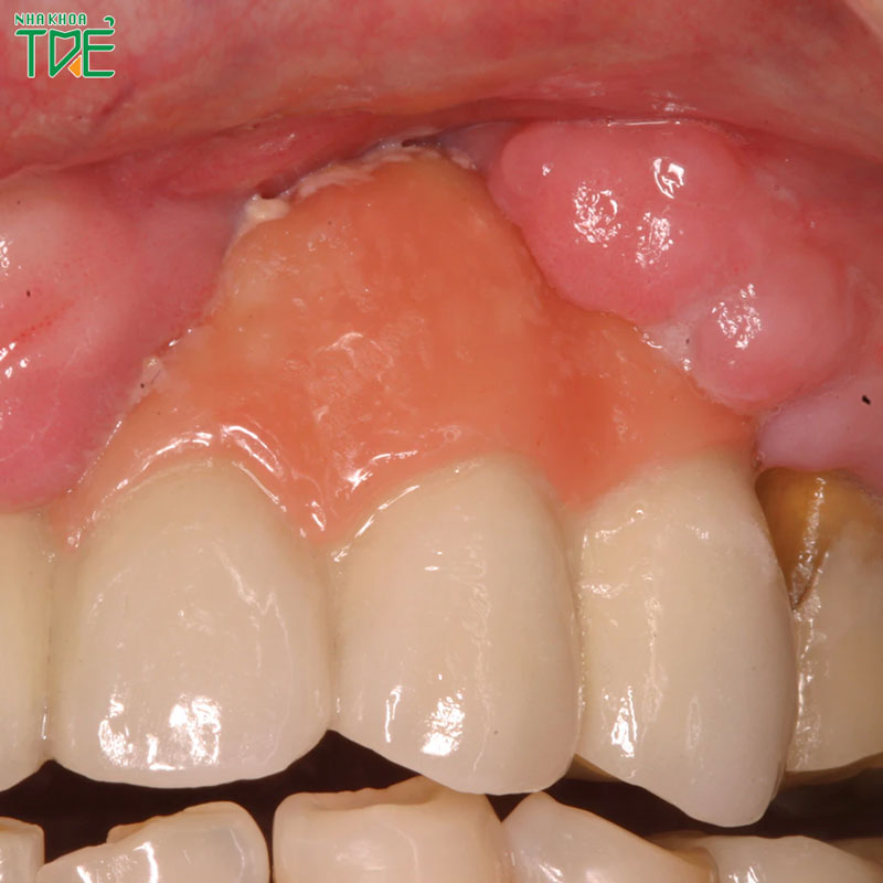 Trồng 3 răng liên tiếp: Phương pháp nào tối ưu nhất?
