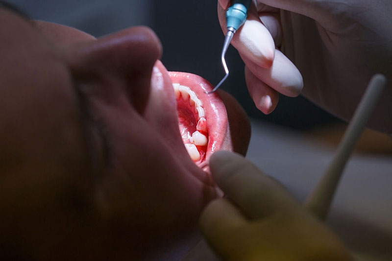Lấy cao răng là bước cơ bản để điều trị tụt nướu