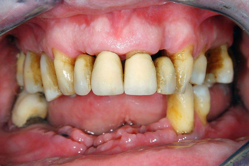 Biến chứng nghiêm trọng của tụt lợi là làm mất răng