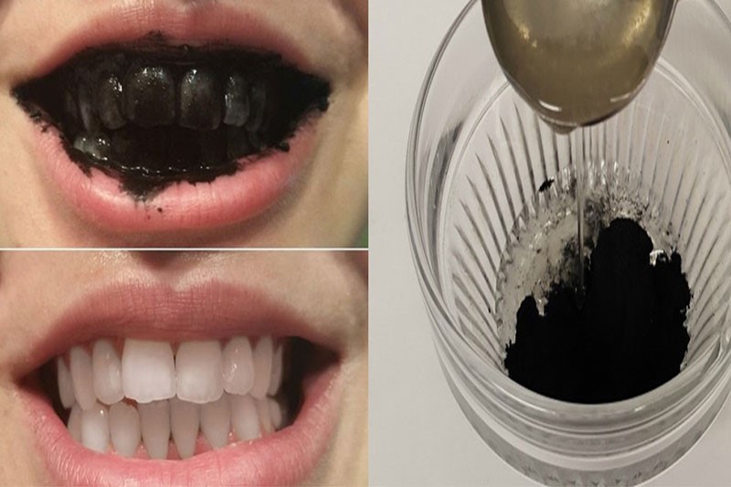 Làm trắng răng bằng than hoạt tính kết hợp với nước là cách đơn giản nhất