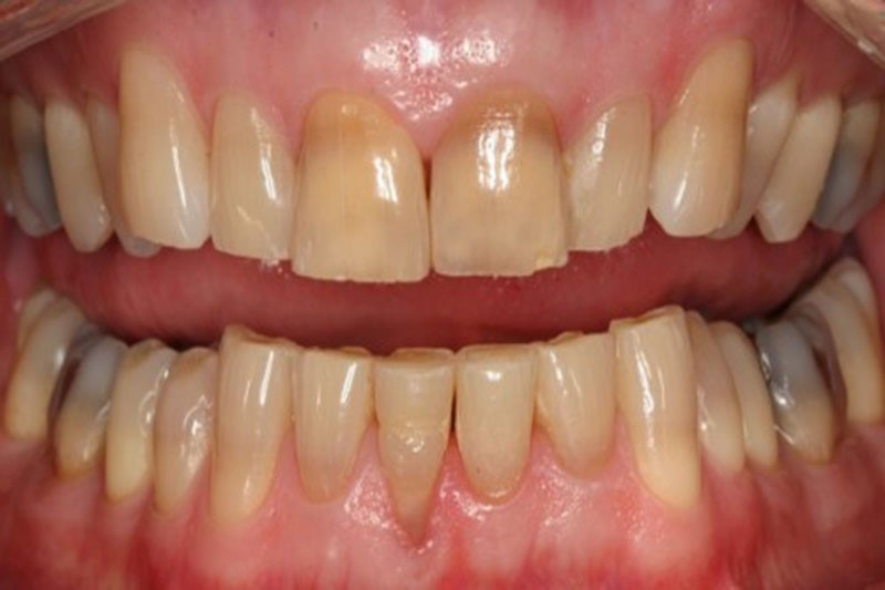 Men răng bị mài mòn khi sử dụng than hoạt tính sai cách
