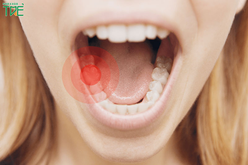 Đau răng hàm dưới: Nguyên nhân và cách điều trị nhanh chóng