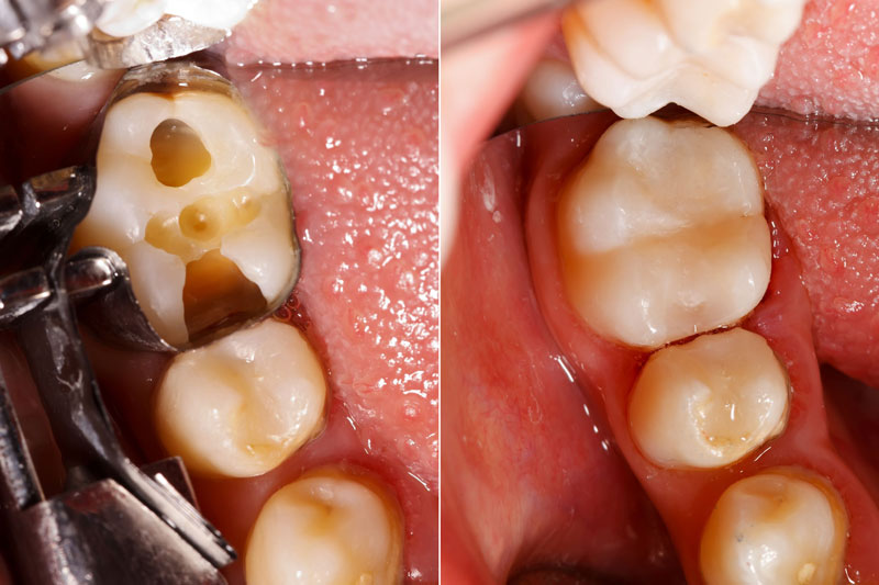 Điều trị sâu răng ngăn ngừa viêm tủy, chết tủy gây đau nhức răng