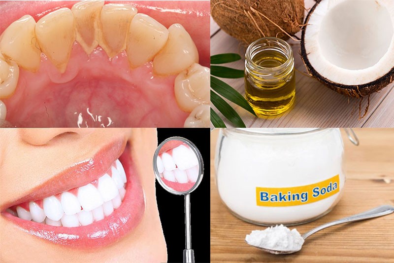 Lấy cao răng bằng dầu dừa kết hợp Baking Soda hiệu quả