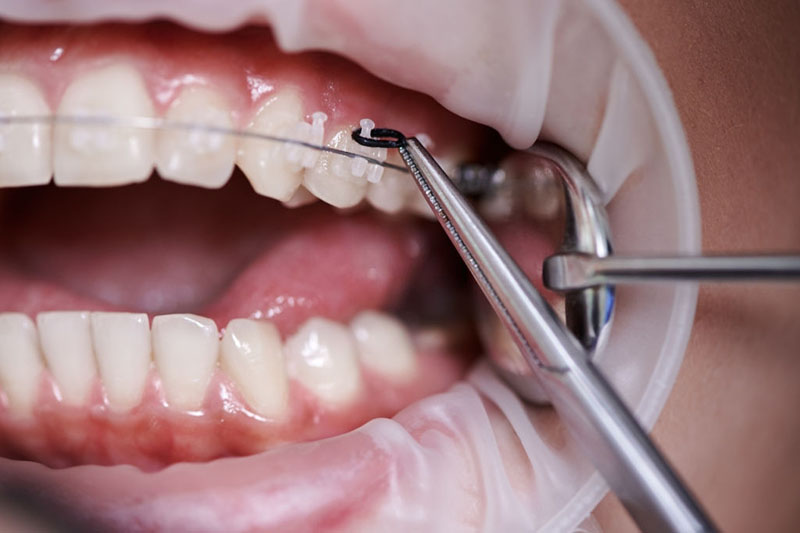 Niềng răng cần đảm bảo đúng kỹ thuật, đúng quy trình để không phải những sai lệch