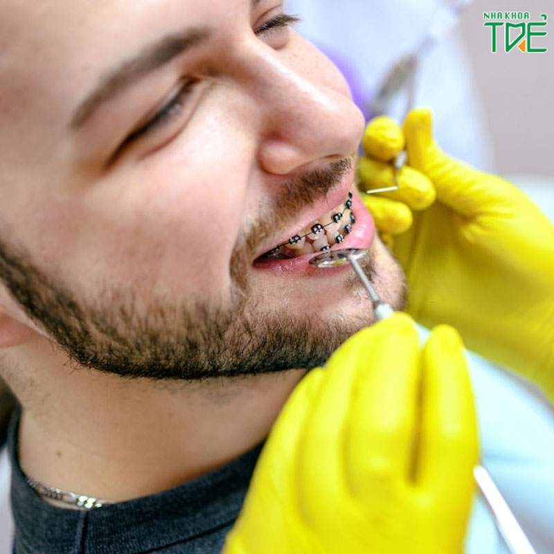 Quá trình niềng răng diễn ra như thế nào?