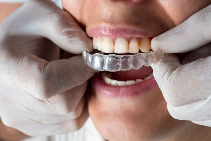 Phương pháp niềng răng hiện đại có thể rút ngắn thời gian chỉnh nha