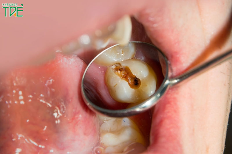 Răng cấm của trẻ bị sâu là tình trạng rất thường gặp