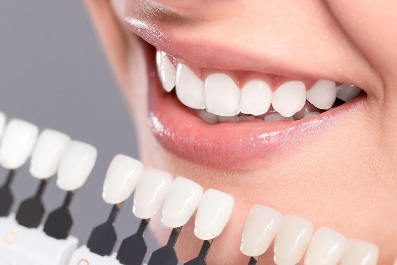 Bọc răng sứ cho răng cửa để sớm sở hữu hàm răng đẹp