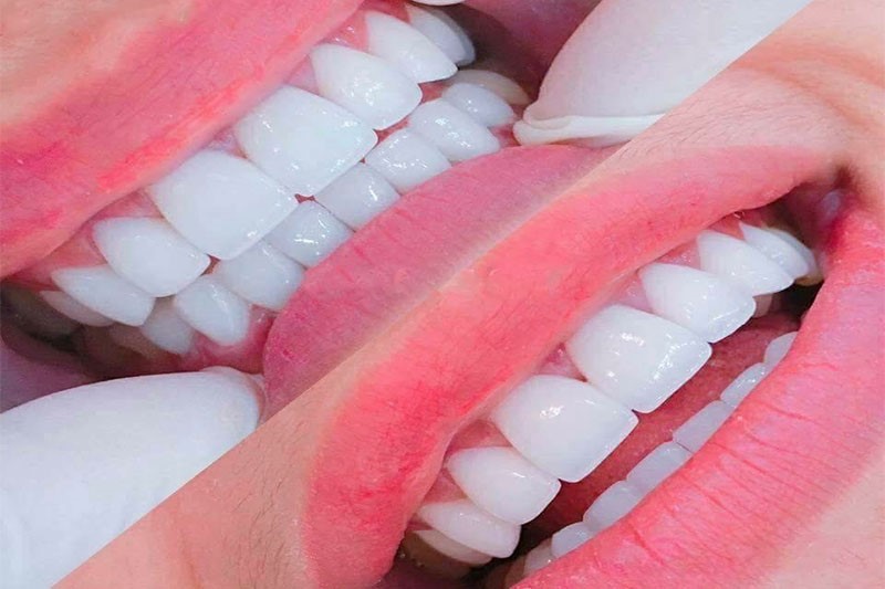 Bọc răng sứ thẩm mỹ khắc phục tình trạng răng bé và thừa