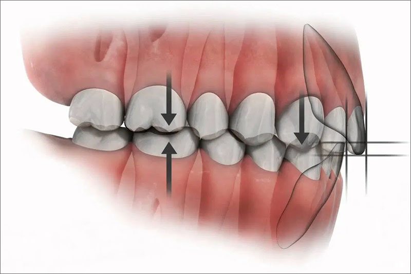 Răng số 6 mọc như nào sẽ tác động đến khớp cắn toàn hàm