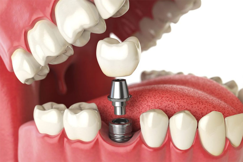 Trồng răng Implant phục hình răng số 6 từ chân răng