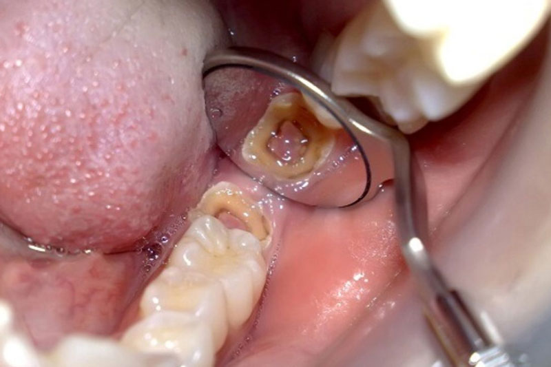 Sâu răng hàm số 7 chỉ còn chân răng thì nên nhổ răng sớm