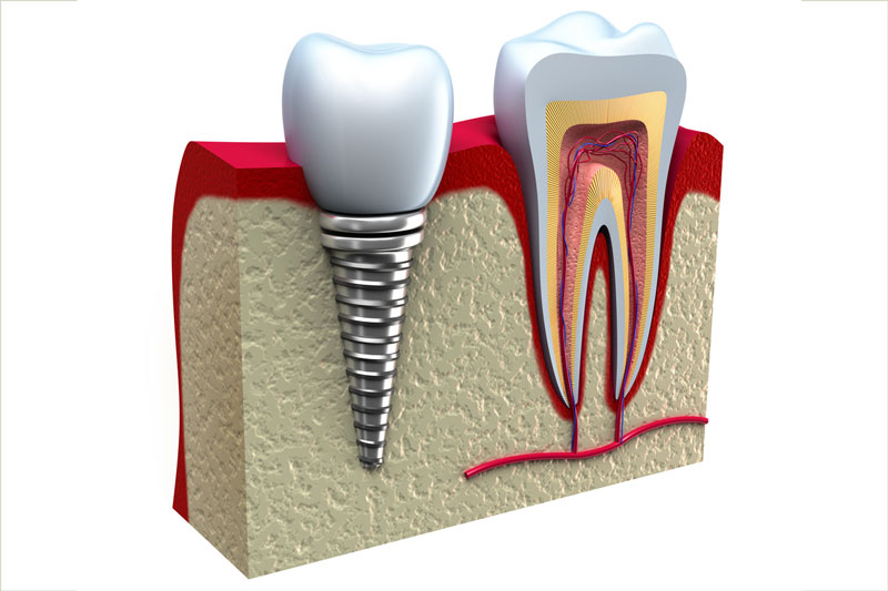 Răng Implant đảm bảo các chức năng tương tự như răng thật