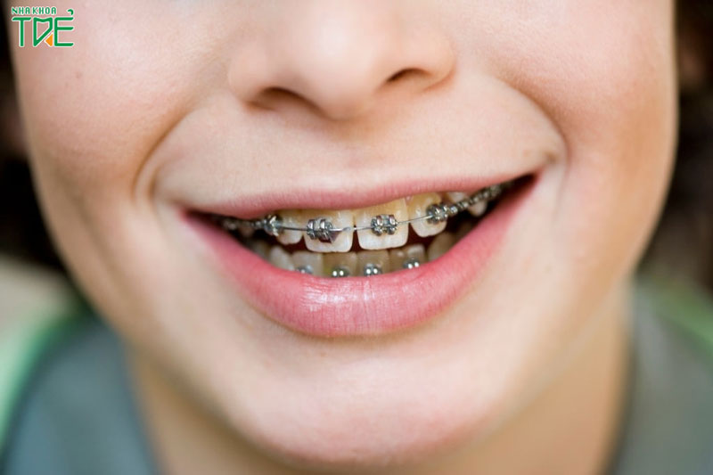Niềng răng luôn là sự lựa chọn hoàn hảo cho hàm răng hô, móm, lệch lạc