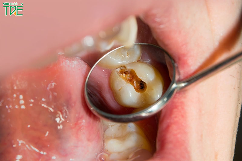 Sâu răng cấm phải làm sao? Răng sâu nên nhổ bỏ hay giữ lại?