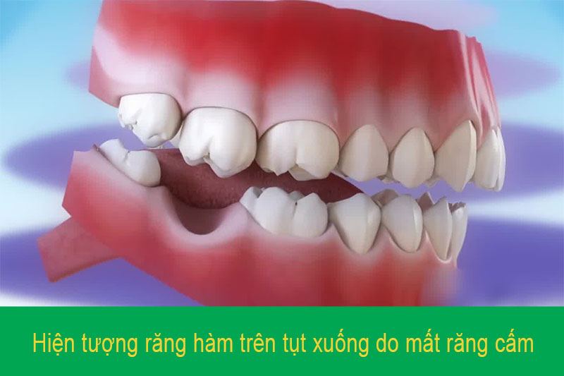 Mất răng cấm gây ra nhiều biến chứng răng miệng