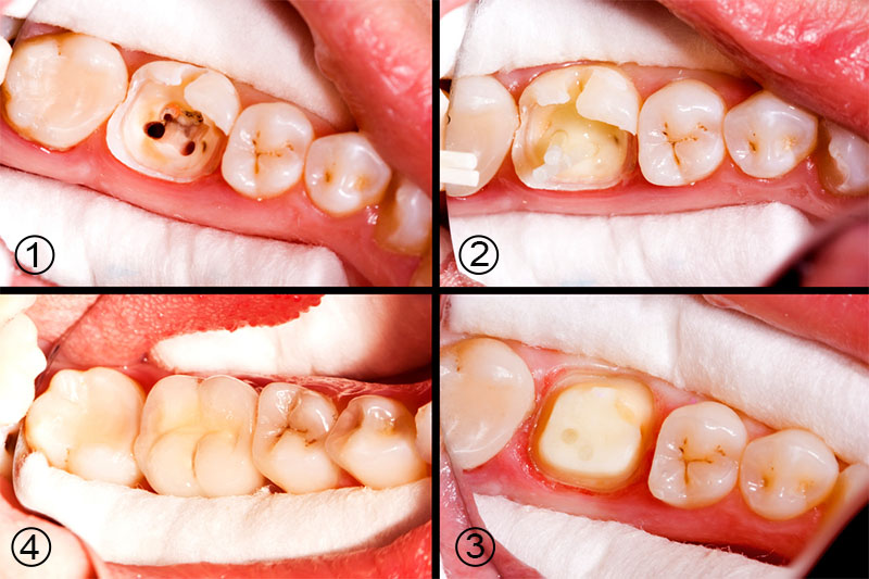 Sau điều trị tủy răng cấm nên bọc răng sứ để phục hình