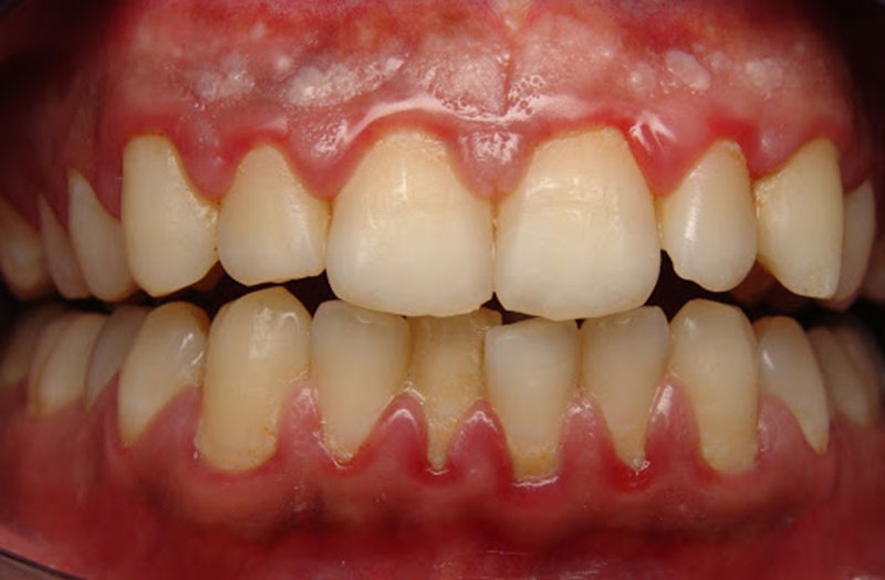  Viêm lợi, viêm nha chu thì nên điều trị triệt để bệnh lý trước khi tẩy trắng răng