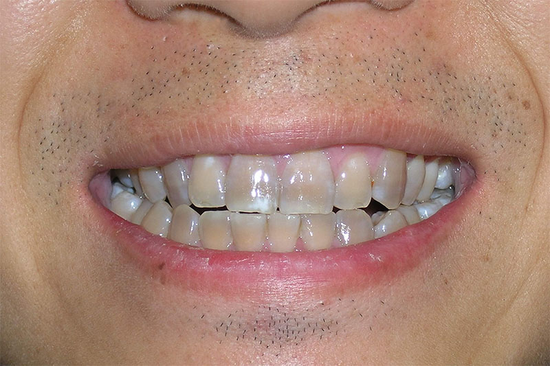 Răng nhiễm màu nặng thì tẩy trẳng răng sẽ không mang lại hiệu quả