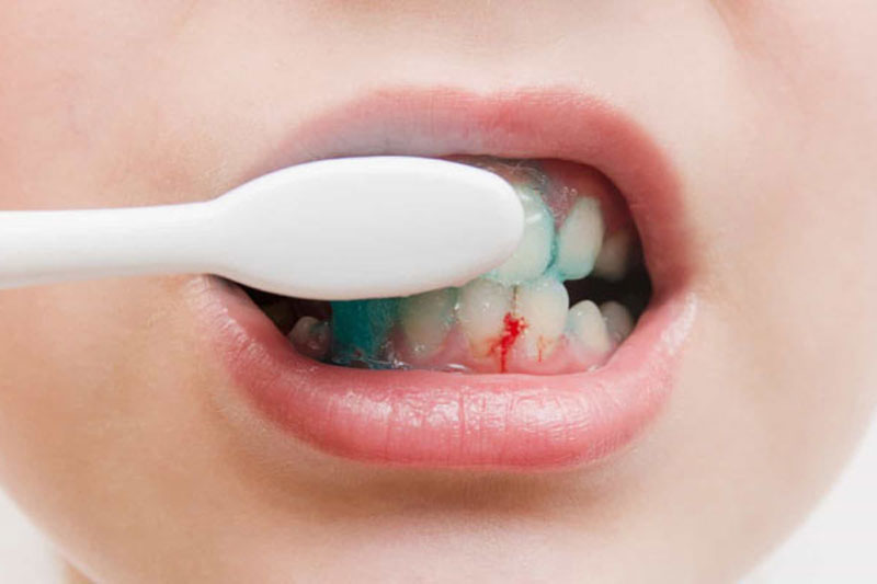 Trẻ 3 tuổi bị chảy máu chân răng có nguy hiểm không?