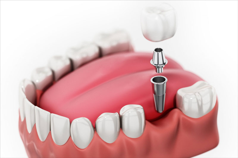 Trồng răng Implant - Phương pháp trồng răng hiện đại