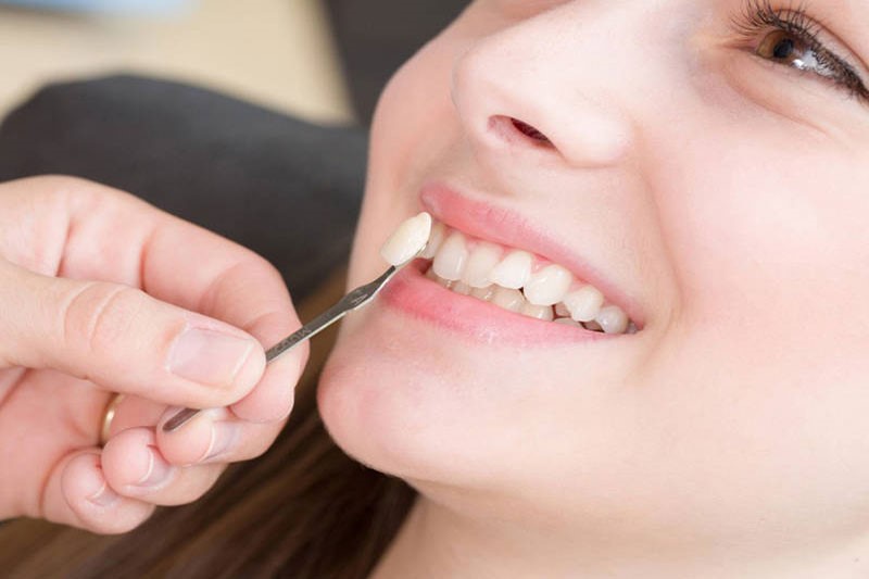 Trồng răng nanh trám Composite tiện lợi, tiết kiệm chi phí nhất hiện nay