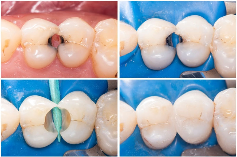 Trám răng hoặc bọc răng sứ để khắc phục răng lỗ sâu răng