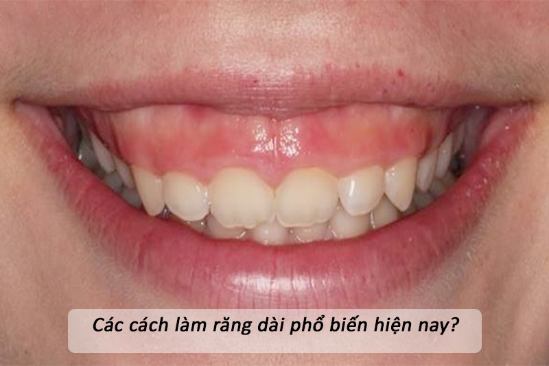Cách làm răng dài được áp dụng phổ biến nhất hiện nay