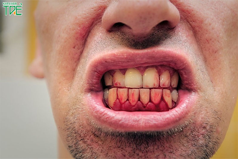 Chảy máu chân răng khi ngủ dậy: Bệnh lý răng miệng không thể xem nhẹ