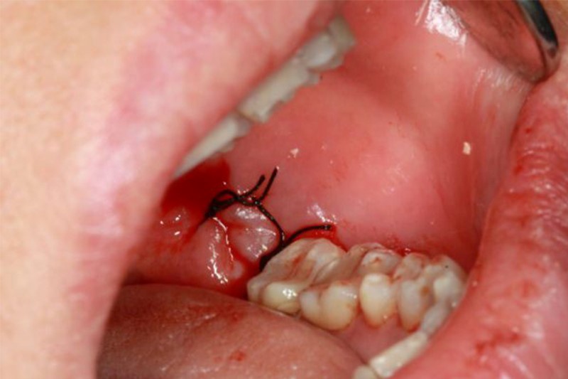 Nhổ răng khôn, phẫu thuật răng miệng của sử dụng chỉ khâu tự tiêu