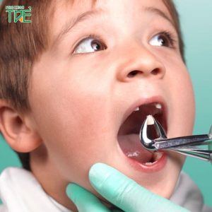 Có nên sử dụng thuốc tê nhổ răng trẻ em không?