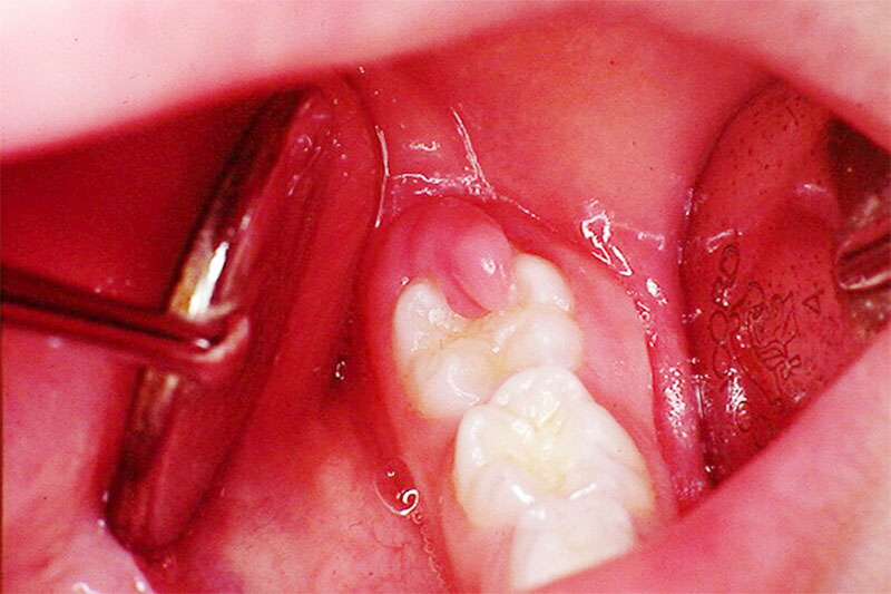 Mọc răng khôn có thể gây viêm nhiễm vùng lợi và gây nổi hạch ở cổ