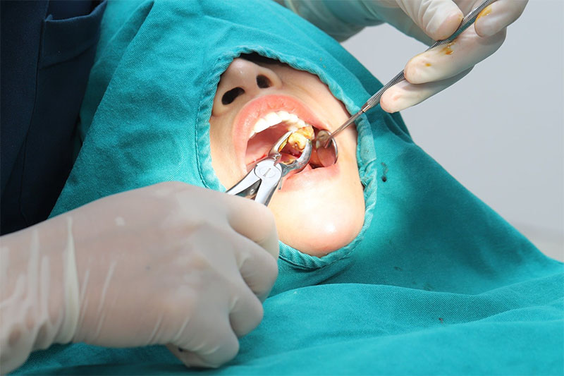 Nhổ răng khôn là cần thiết để không gặp phải biến chứng nguy hiểm