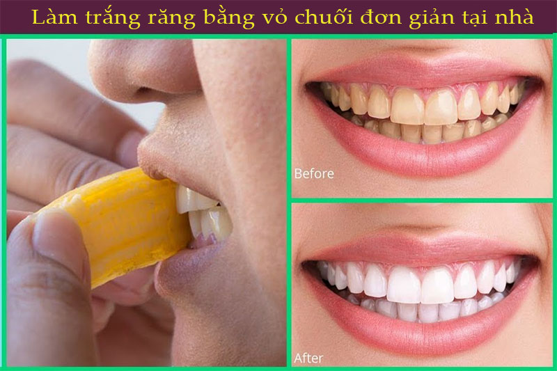Làm trắng răng bằng vỏ chuối được nhiều người áp dụng