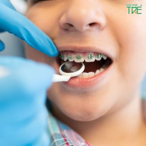 Lưu ý khi niềng răng cho trẻ: 5 vấn đề cần quan tâm hàng đầu