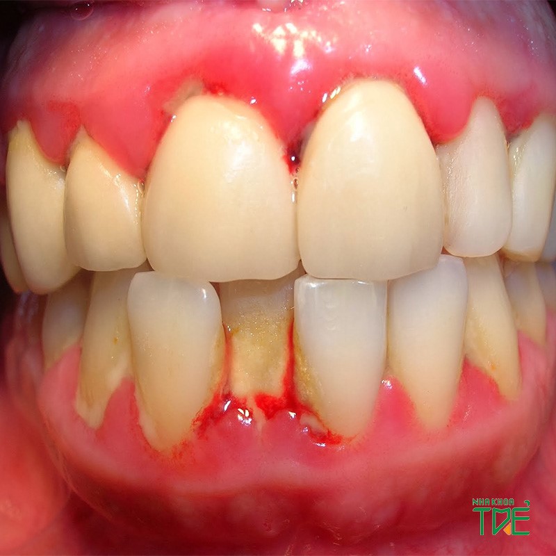 Sưng lợi ở răng cửa có thể gây nguy hiểm đến sức khỏe răng miệng và có nguy cơ mất răng vĩnh viễn. Vậy nguyên nhân do đâu và cách điều trị như nào?